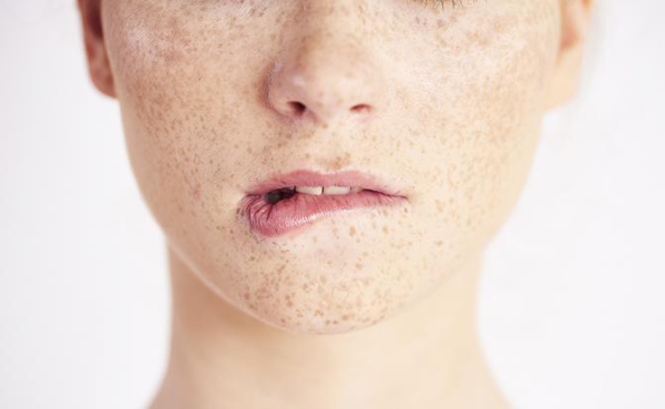 Что нужно знать о лазерной эпиляции при гиперпигментации и склонности к рубцеванию