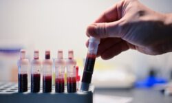 Ученые нашли способ выявлять болезнь Альцгеймера за десятилетия до симптомов